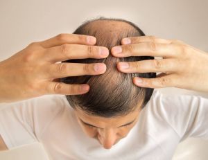 Calvitie, alopécie, pelade, comment y remédier ? / iStock.com-Manuel-F-O
