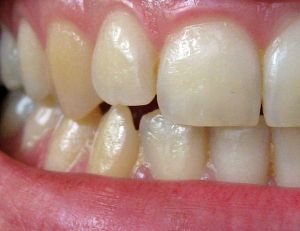 Bientôt une dent bluetooth connectée à votre médecin
<p></p>
