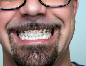 L'orthodontie pour les adultes