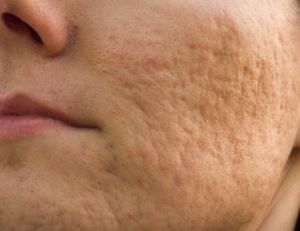 Comment traité les cicatrices d'acné ?