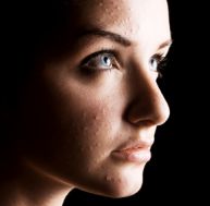 Quelles solutions pour traiter l'acné chez l'adulte ?