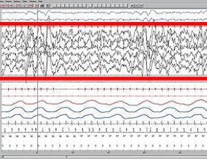 EEG ou électro-encéphalogramme