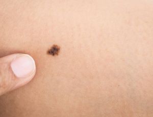 Cancer de la peau : compter ses grains de beauté servirait d'indicateur / iStock.com - PhanuwatNandee