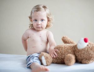 Maladies infantiles : tout savoir sur la varicelle / iStock.com - Deucee_
