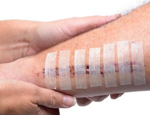 Traitement des cicatrices : quelles solutions ?